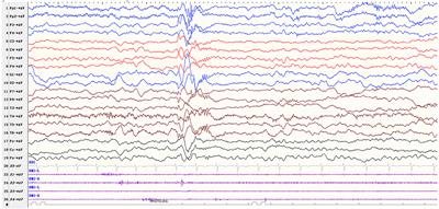 Startle-Induced Epileptic Spasms: A Clinical and Video-EEG Study